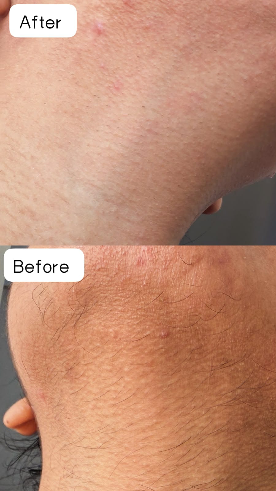 Before and after result of a VELORA client showing smoother neck skin with reduced hair.