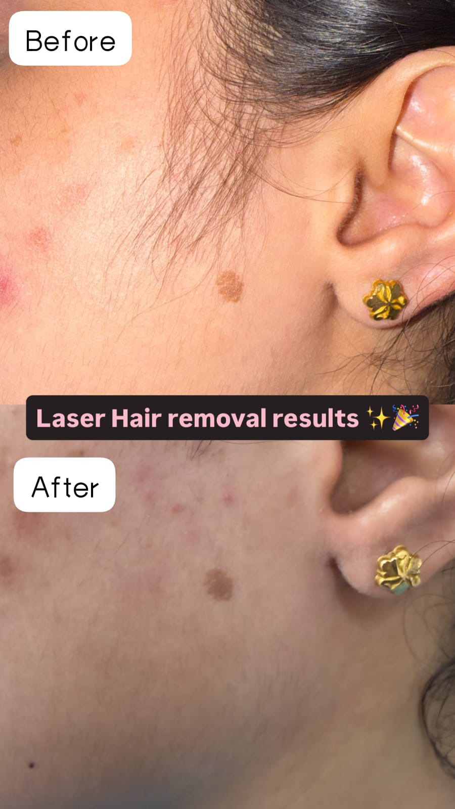 Before and after result of a VELORA client showing reduced facial hair along the jawline.
