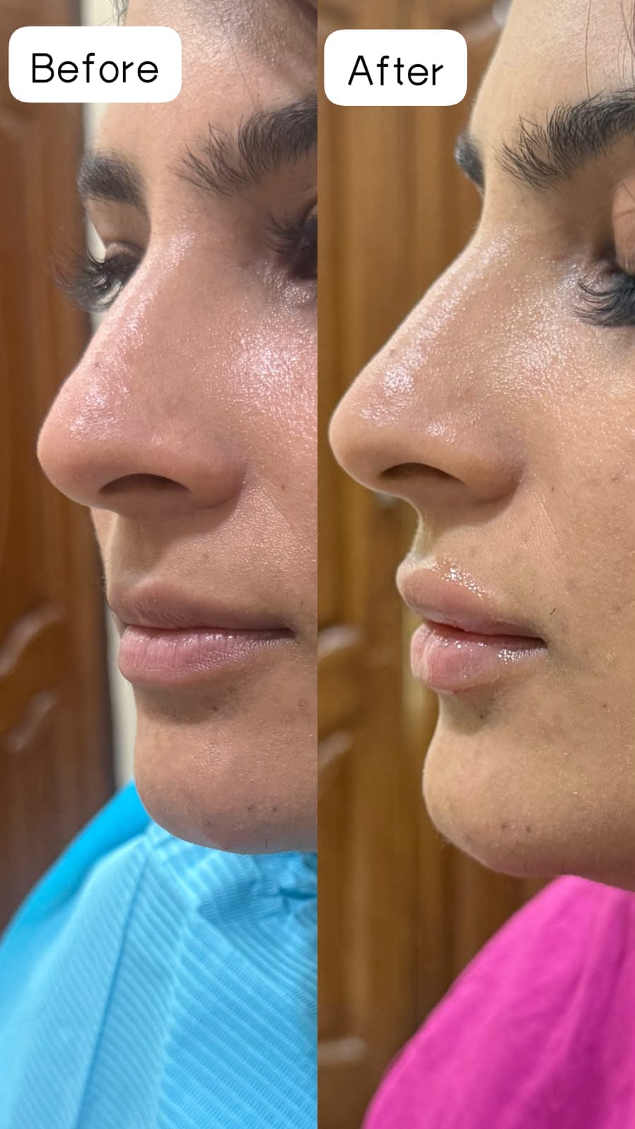 Before and after side profile of a VELORA client showing refined lip appearance.