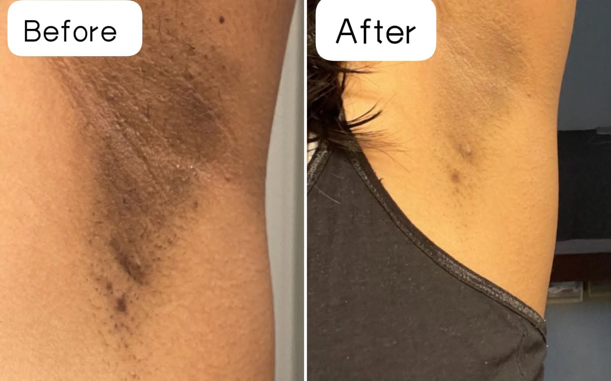 Before and after result of a VELORA client showing smoother, clearer underarm skin.