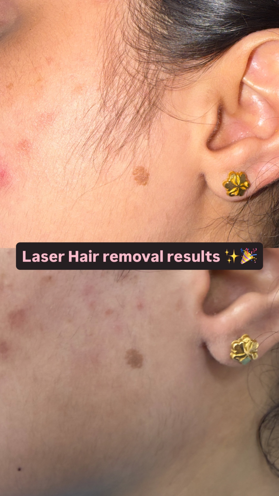 Before and after result of a VELORA client showing improved skin clarity near the jawline.